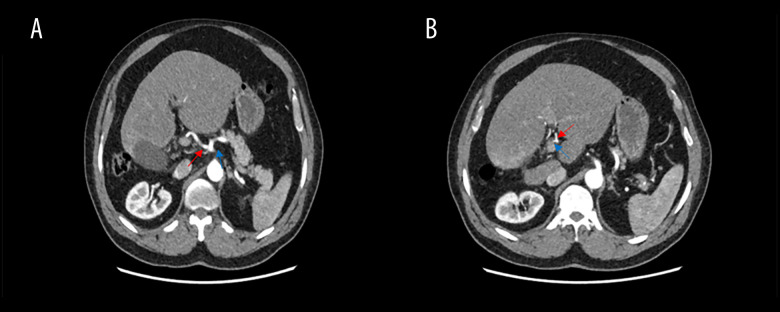 Right Hepatic Lobe Hypoplasia and Gangrenous Cholecystitis: Surgical Implications and Case Report.