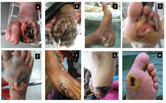 Role of Biomarkers in Diabetic Foot Osteomyelitis.