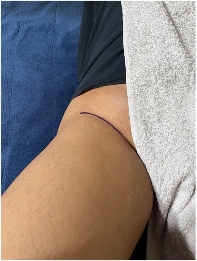 Bikini versus Traditional Incision in DAA THA: Patient Satisfaction, Surgeon Observation, and LFCN Damage.