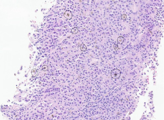 Partial Nephrectomy as Management of Oligometastatic Cancer with Limited Systemic Treatment Options: A Case Report.