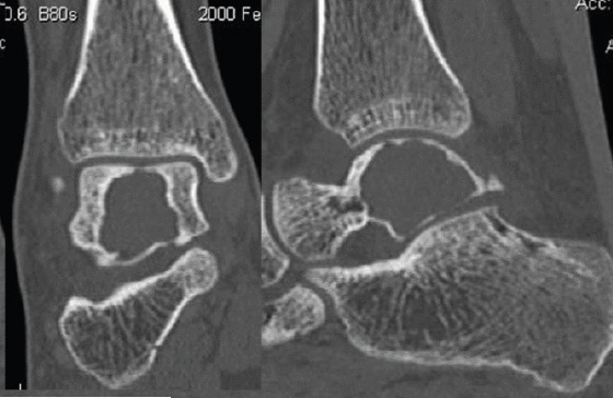 Aneurysmal Bone Cyst of Talus: A Case Report.