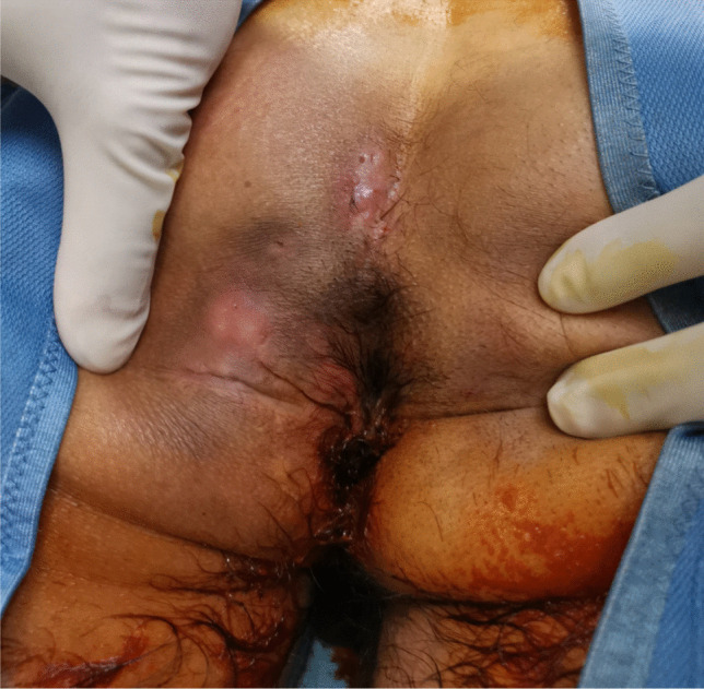 Intra-operative ultrasound in the surgical treatment of complex and recurrent pilonidal disease: a retrospective, observational, single-center study.