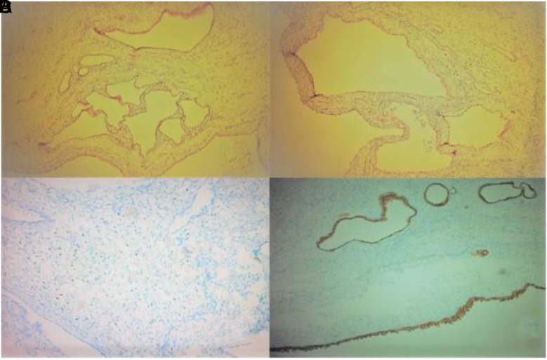 Massive Cystic Nephroma in a 13-Month-Old Girl: Case Report and Differential Diagnostic Outcome.