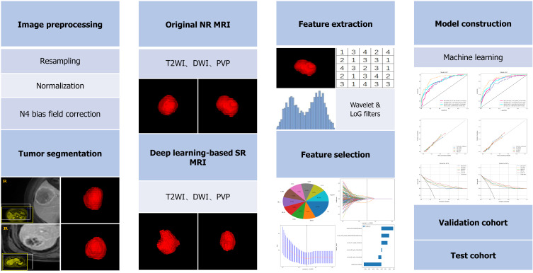 Multiparametric magnetic resonance imaging of deep learning-based super-resolution reconstruction for predicting histopathologic grade in hepatocellular carcinoma.