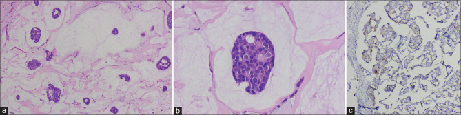 Primary Cutaneous Mucinous Carcinoma: A Rare Entity.