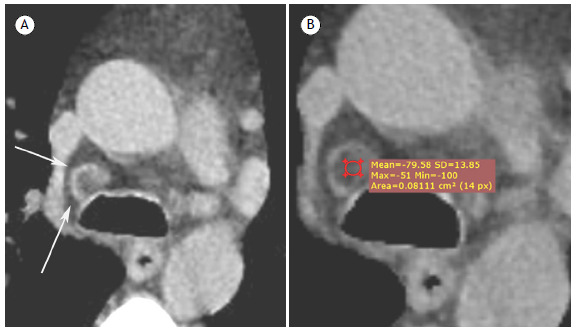 Lymph node with central hypodensity.