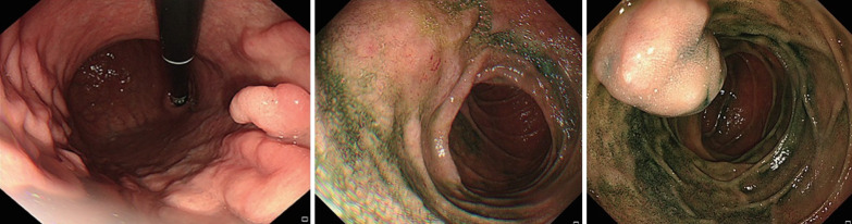 A Case of Neurofibromatosis Type 1 With Early Gastric Cancer and Multiple Small Bowel Gastrointestinal Stromal Tumors.