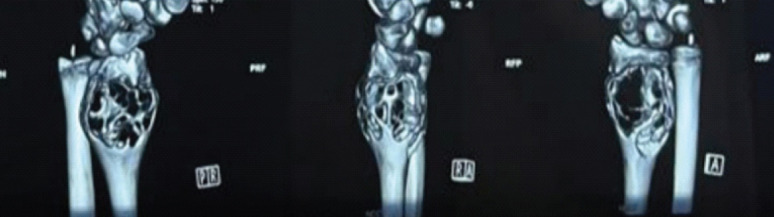 A Novel, Joint Sparing Surgical Approach to the Management of Giant Cell Tumor of the Distal Radius in a Pediatric Patient: A Case Report and Comprehensive Literature Review.