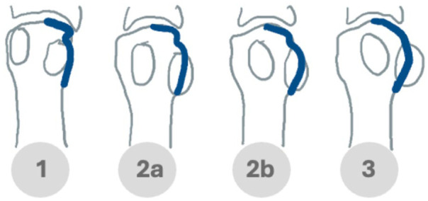 Metatarsal Pronation on Radiographs: A Prospective Reliability Study of Visual Rotation Markers in Hallux Valgus.