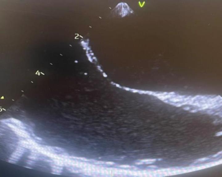Eustachian valve endocarditis in patients with Fournier's gangrene and septic shock: A rare case and a literature review.