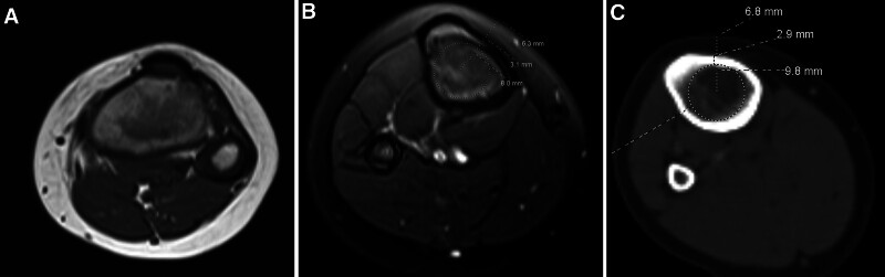 Evaluating the Safety of Current Intraosseous Needles and the Potential for Age-Based Guidance Using a Large-Scale Pediatric CT/MRI Imaging Study.