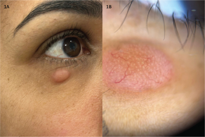 Solitary Facial Nodule in a Young Female Patient: A Quiz.