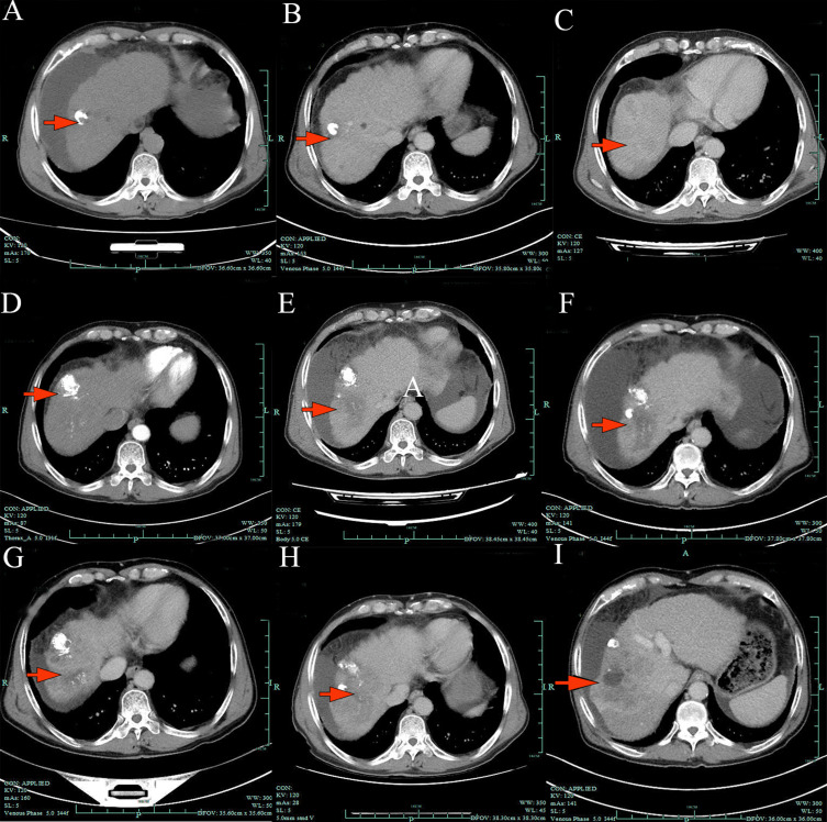 Durable Control of Multi-Refractory HBV-HCC with Bevacizumab/Sintilimab/Lenvatinib Triplet Therapy.