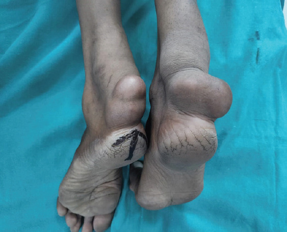 Massive Tendo Achilles Xanthoma Treated with en bloc Excision and Reconstruction with Flexor Hallucis Longus Tendon Transfer: A Case Report.