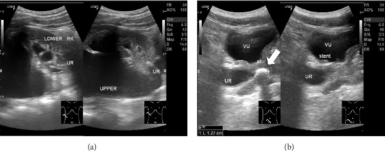 Complete Duplex Right Kidney With Upper Moiety Hydronephrosis due to Ureteral Stone: A Rare Case.
