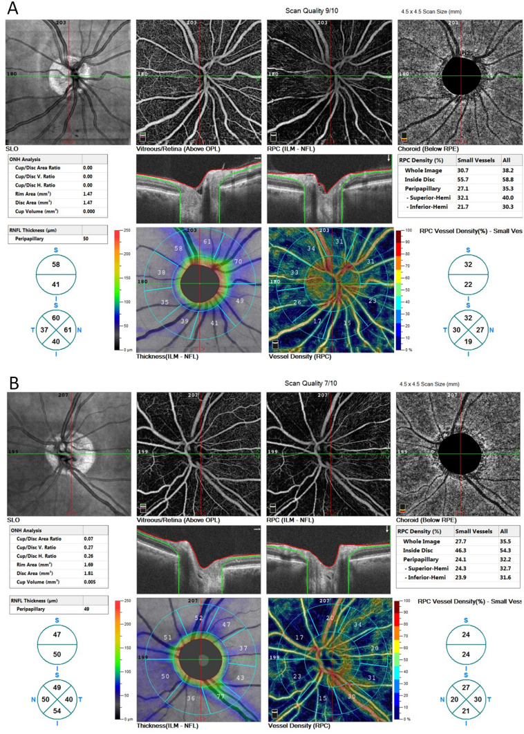 Septo-Optic Dysplasia Plus with Bilateral Homonymous Hemianopia - Case Report.