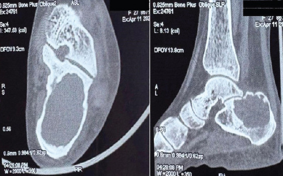Calcaneal Giant Cell Tumor Masquerading as Lateral Ankle Sprain - A Rare Case Report and Review of Literature.