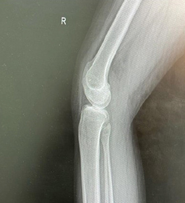 Congenital Absence of Bilateral Patella in an Active Military Personnel Case Report.