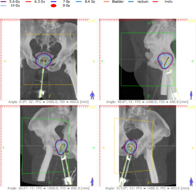 Dosimetry evaluation and uncertainty analysis of Cobalt-60 HDR brachytherapy for cervical cancer in resource-limited settings.