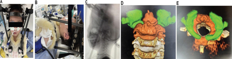 A Case of Atlanto-Axial Rotatory Fixation Requiring Internal Fixation.