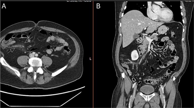 Ileocolic venous thrombophlebitis from associated enteropathogenic <i>E. coli</i> infection.