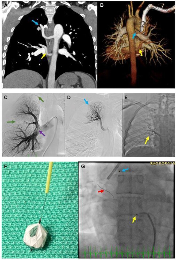 Case report of transcatheter flow restriction in isolated non-redundant major aorto-pulmonary collateral arteries.