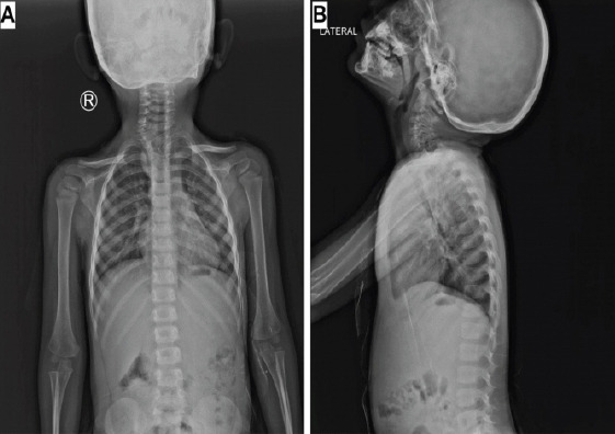 Isolated Anterior Extradural Enterogenous Cyst of the Thoracic Spine Mimicking an Anterior Thoracic Meningocele: A Case Report.