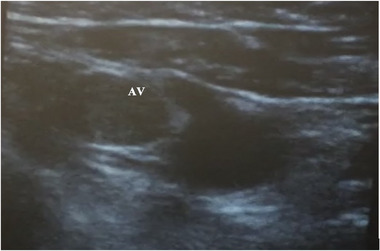 Ultrasound Guided Venous Access for Cardiac Devices: Defining Learning Curve for Safety, Efficacy, and Radiation Exposure.