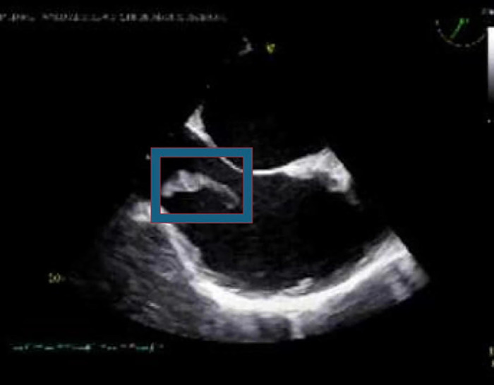 Eustachian valve endocarditis in patients with Fournier's gangrene and septic shock: A rare case and a literature review.
