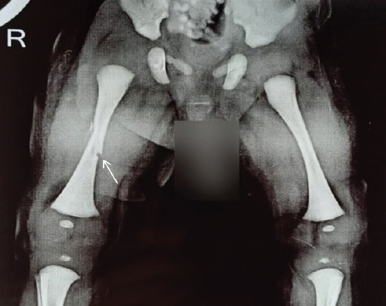 Obstetric Neonatal Femur Fracture During Emergency Cesarean Section for Breech: A Case Report.