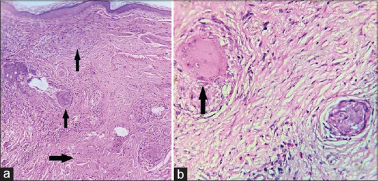Morpheaform Sarcoidosis - A Very Rare Presentation of Sarcoidosis with a Brief Review of Literature.