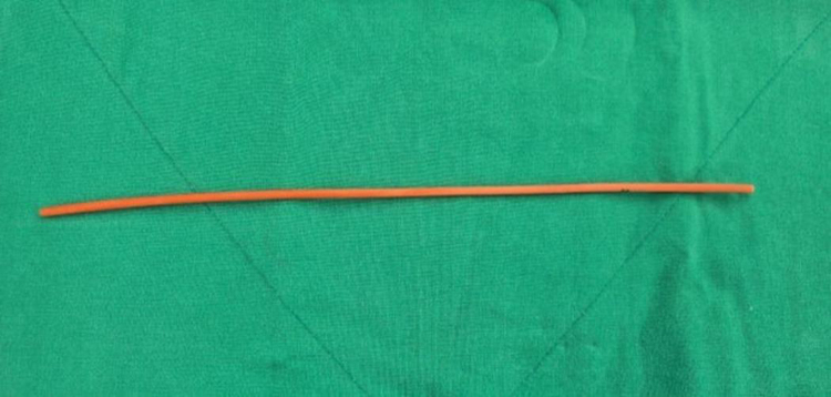 Subdural and epi-arachnoid hemorrhage following spinal epidural block requiring hematoma removal: illustrative case.