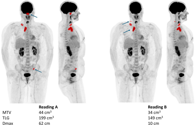 Inter-reader agreement of quantitative FDG PET/CT biomarkers in lymphoma: a multicentre evaluation of MTV, TLG and Dmax.