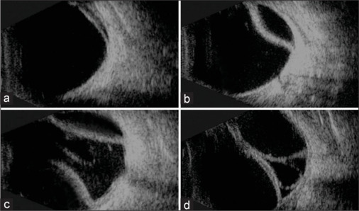 The risk factors of shallow anterior chamber after choroidal detachment in glaucoma patients with intraocular surgery.