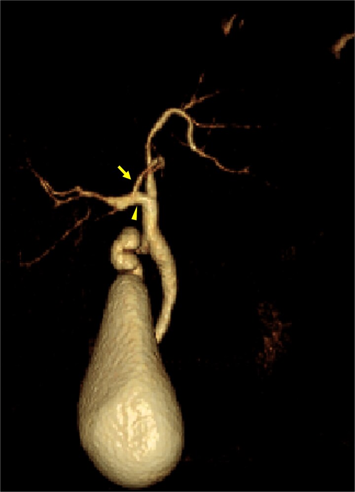 A case of the left medial sectional bile duct joining the right hepatic duct.