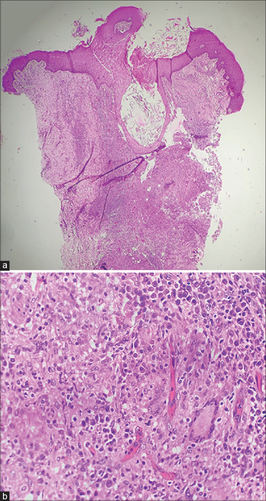 Trans-Epidermal Elimination Due to Insulin Formulation: Report of a Rare Adverse Effect.