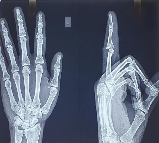 Dynamic External Fixation Using Suzuki Frame for Intra-articular Middle Phalanx Base Fracture with Dorsal Subluxation: A Case Report.