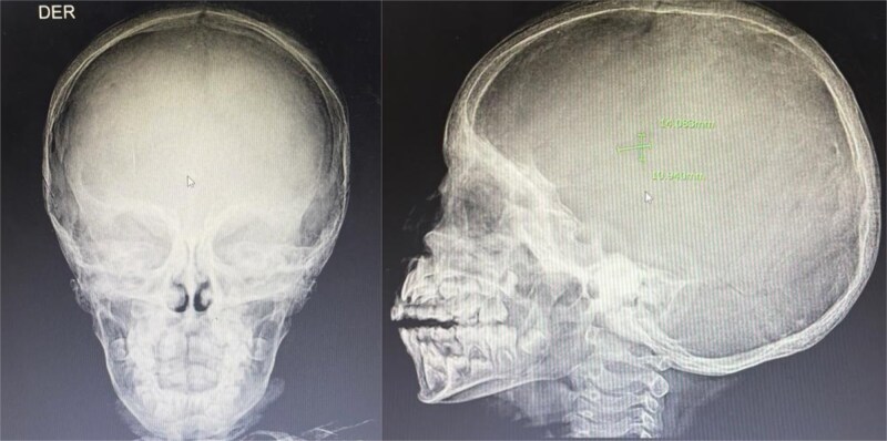 A rare case of Langerhans cell histiocytosis with unexplained endocrine dysfunction and extensive skeletal involvement in a Pediatric patient.
