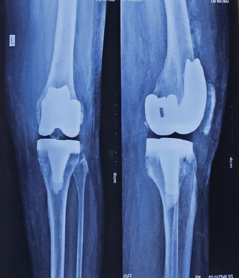 Rare Case of Heterotopic Ossification Impinging on the Quadriceps Mechanism Following Total Knee Replacement: A Case Report.