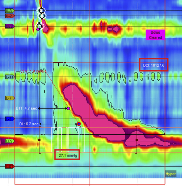 Where the Jackhammer Meets the Corkscrew: A Case of Manometric Hypercontractile Esophagus and Esophagogastric Junction Outflow Obstruction With Endoscopic Features of Distal Esophageal Spasm.