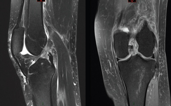 Inverted Cyclops Lesion Following Anterior Cruciate Ligament Repair: A Case Report.
