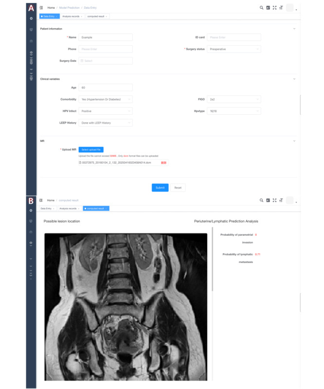 Machine Learning for Preoperative Assessment and Postoperative Prediction in Cervical Cancer: Multicenter Retrospective Model Integrating MRI and Clinicopathological Data.
