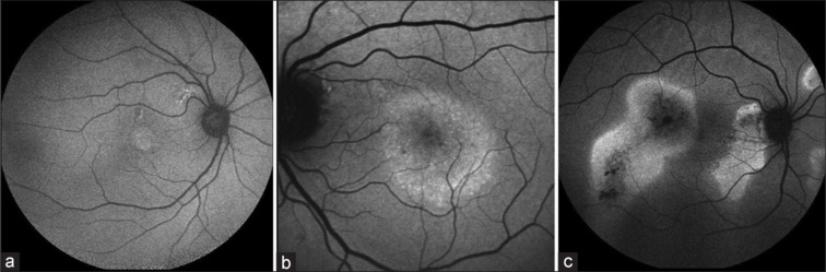 Central serous chorioretinopathy imaging biomarkers as potential indicators of response to subthreshold nanosecond laser.