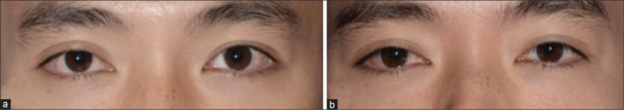 Impact of unilateral Mueller's muscle conjunctival resection on contralateral upper eyelid position in patients without preoperative Hering's effect.