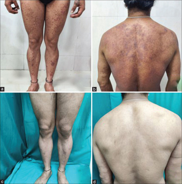 Successful Treatment of Psoriasis in HIV with Secukinumab.