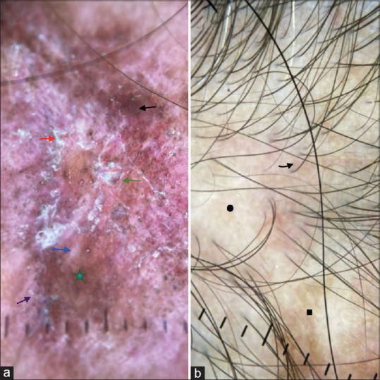 Parry-Romberg Syndrome with Localized Plaque Morphea and Localized Discoid Lupus Erythematosus: A Case Report of a Rare Overlap.