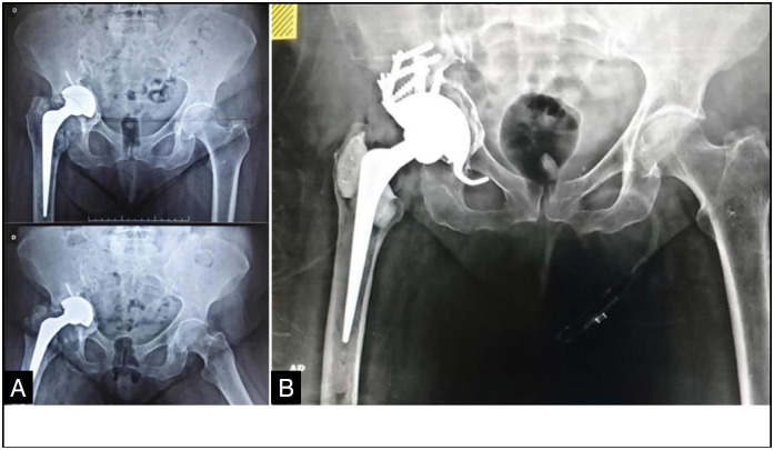RADIOGRAPHIC AND FUNCTIONAL EVALUATION OF HIGH POROUS METAL OSSEOINTEGRATION IN ACETABULAR REVISIONS WITH PELVIC DISSOCIATION.