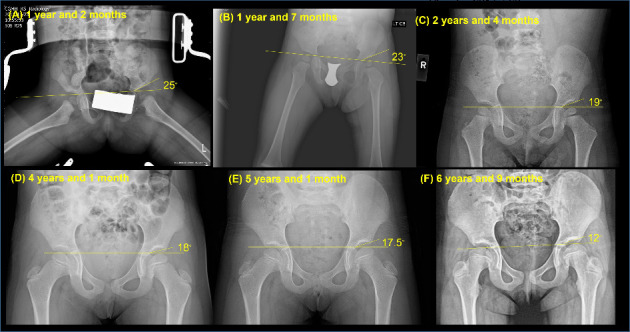 Physical Therapy Management for Delayed Diagnosis of Developmental Dysplasia of the Hip: A Case Report.