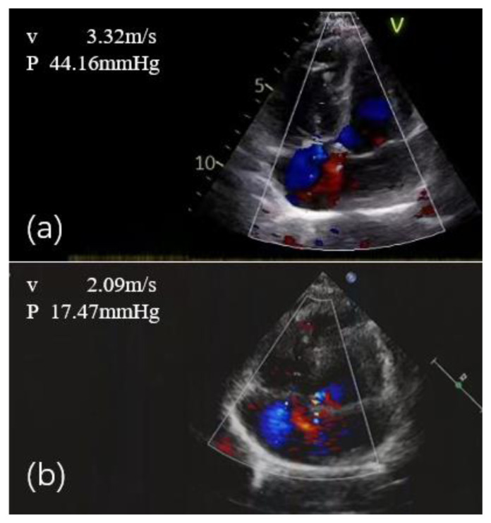 Luspatercept Treatment in a β-Thalassemia Patient with Pulmonary Arterial Hypertension: A Case Report.