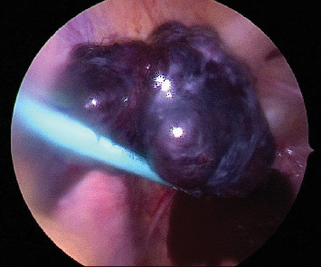 Ovarian Torsion in Normal Ovaries in Reproductive-Aged Women.